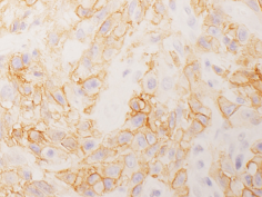 悪性胸膜中皮腫におけるPD-L1(CD274)発現