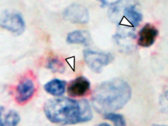 悪性胸膜中皮腫微小環境における制御性T細胞(矢頭; 赤, CD4; 茶, FoxP3)